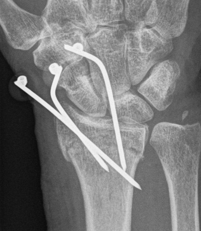 Distal Radius Fracture K wires AP